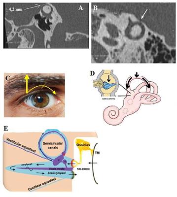 Proposal for a Unitary Anatomo-Clinical and Radiological Classification of Third Mobile Window Abnormalities